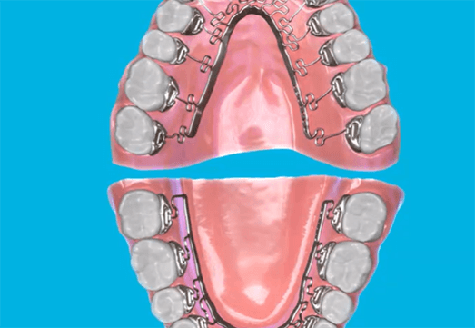 Brava braces attached to the backs of teeth