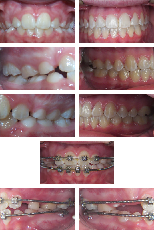Teeth at various stages of the orthodontic treatment process