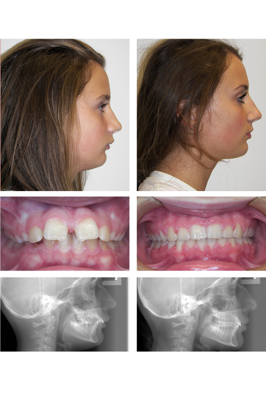 View of patient's profile, teeth, and x-rays through the orthodontic process