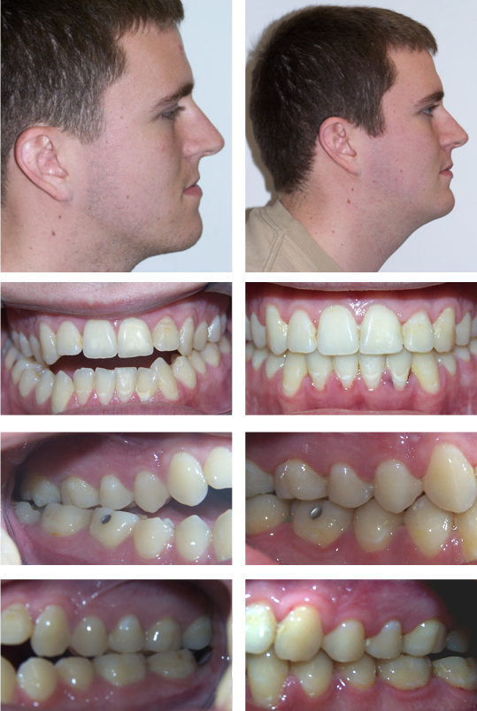 Eight images of patient's smile at different stages of orthodontic treatment