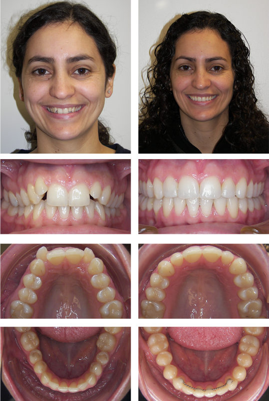 Smile before and after orthodontic treatment