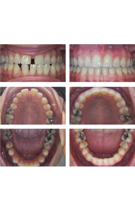 Smile with gaps before dental treamtent and corrected alignment after orthodontic treatment