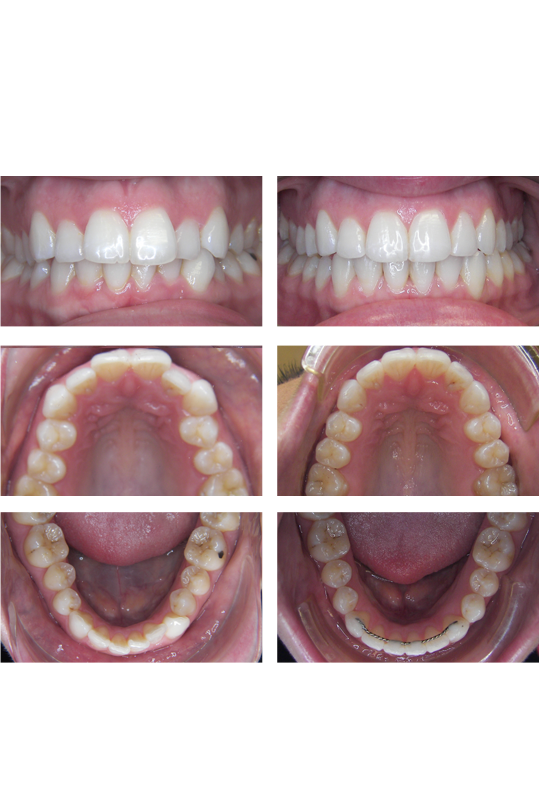 Three different views of a smile before and after orthodontic treatment