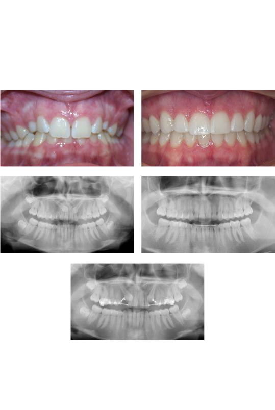 Patient's smiles and x-rays of treatment progress before and after dental care