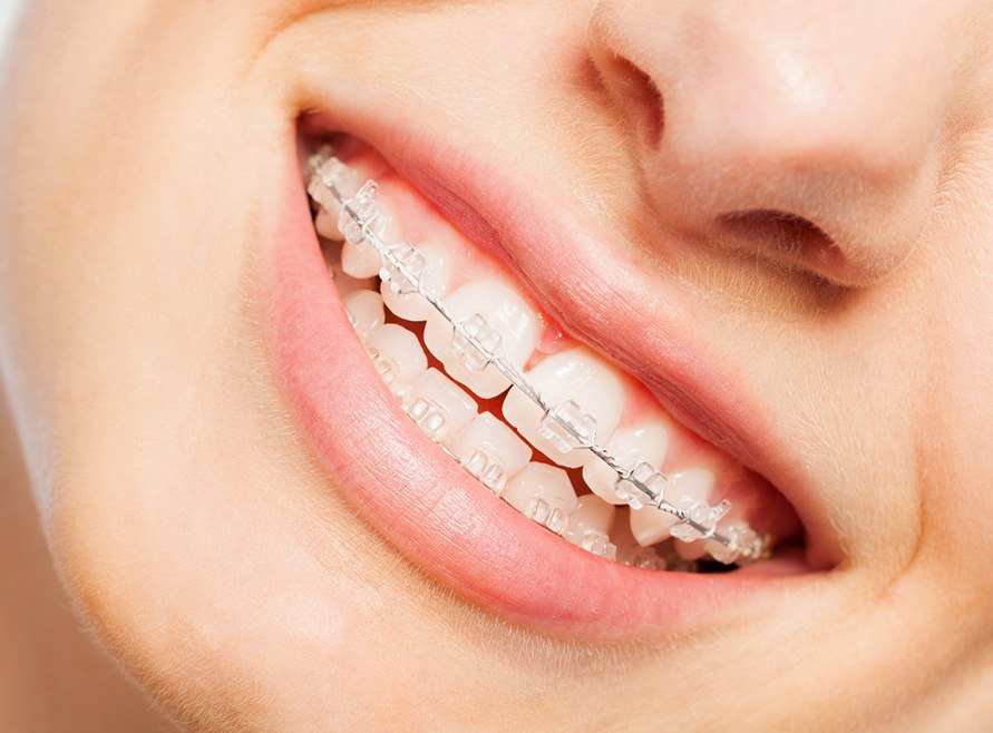 a closeup of a person’s mouth who has ceramic braces