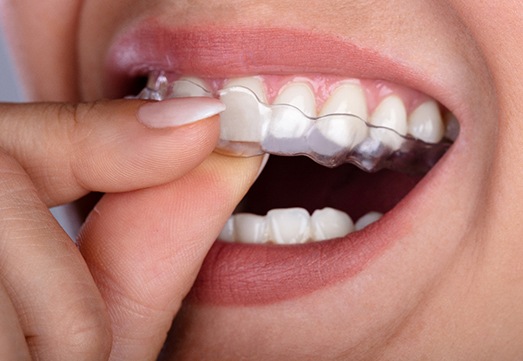 Closeup of woman removing clear aligner from upper arch