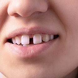 Nose-to-chin closeup of a woman with a pronounced gap in top teeth