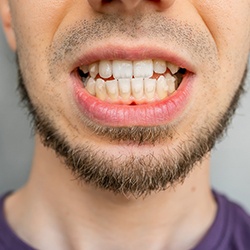 Nose-to-neck view of man with underbite and clear aligner attachments on enamel