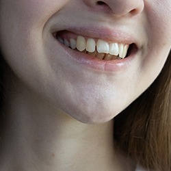 Nose-to-neck view of woman with open bite smiling