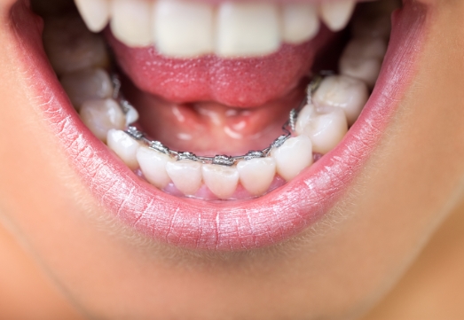 Smile with lingual braces