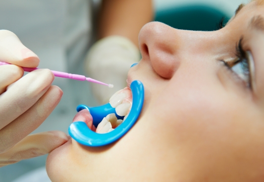 Child receiving silver diamine fluoride treatment