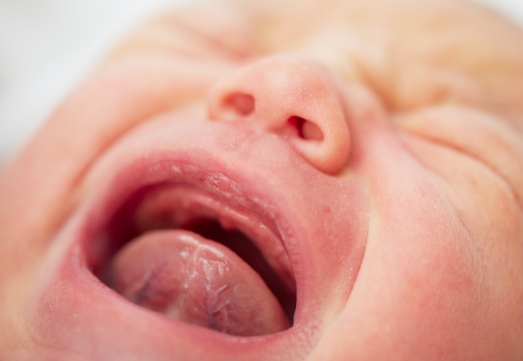 Crying baby in need of lip and Tongue-Tie treatment