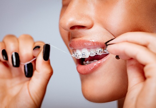 Closeup of patient flossing with braces in Arlington Heights