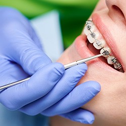 Closeup of woman’s braces being examined by dentist