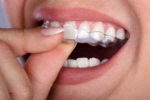 a woman getting clear aligners from her dentist