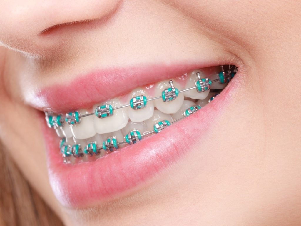 person wearing braces